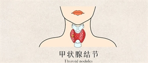 Show details for Thyroid Nodules Picture of Thyroid Nodules